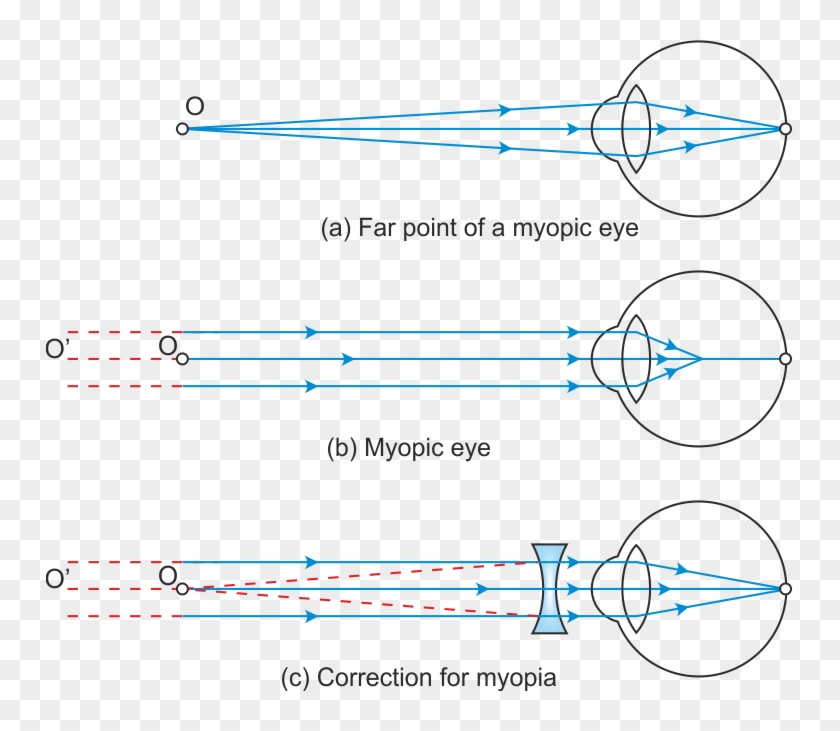 Hypermetropia Or Far Sightedness Far Point And Near Point Of Myopic Eye Hd Png Download 747x651 Pngfind