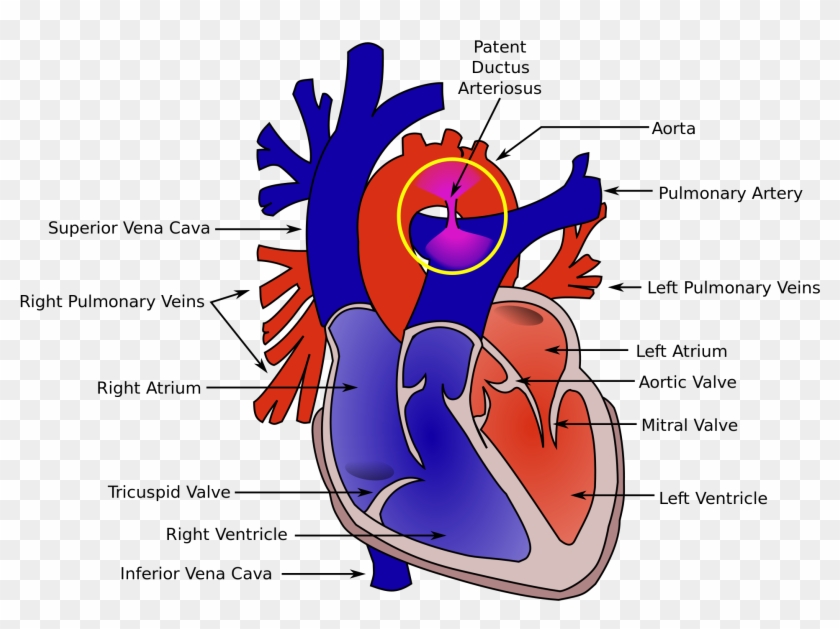 Ductus Botalli Patent Ductus Arteriosus, HD Png Download 2000x1432