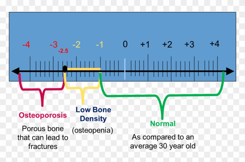 Understanding Bone Density Results - Scale Of Osteoporosis, HD Png ...