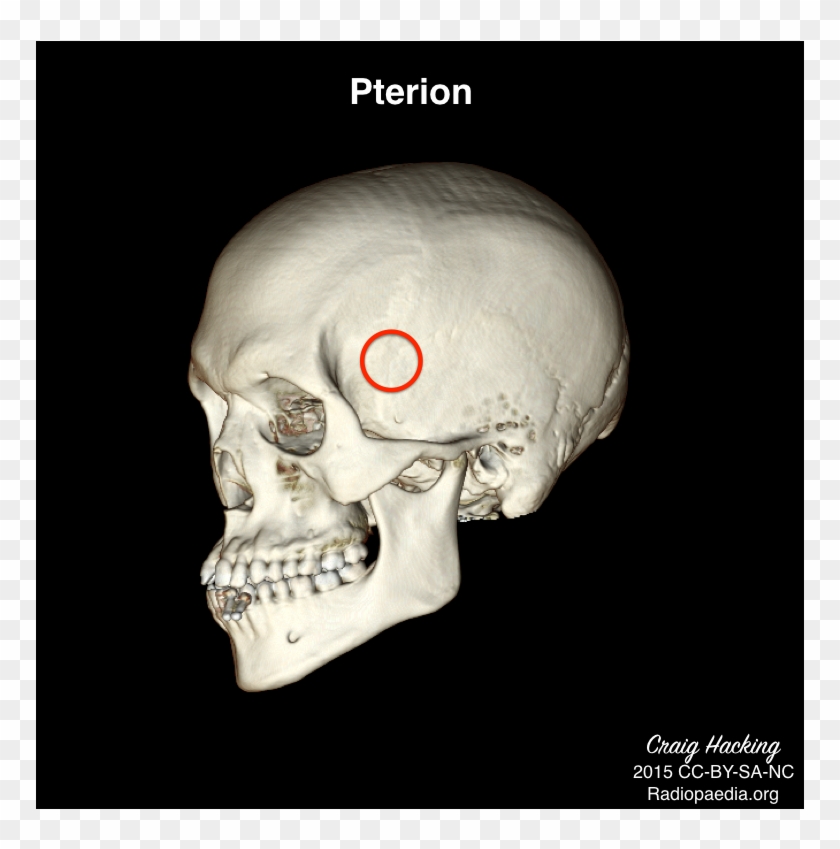 Череп указывать. Птерион и Астерион. Птерион на черепе. Череп Астерион птерион. Птерион анатомия.