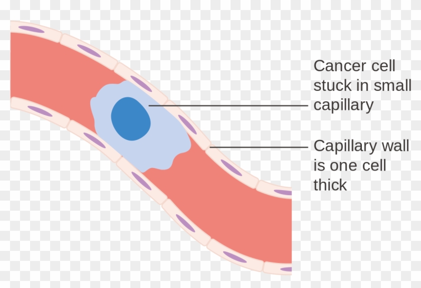 Diagram Showing A Cancer Cell Stuck In A Small Blood - Diagram Of Blood