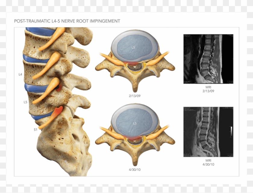 L5 Nerve Impingement