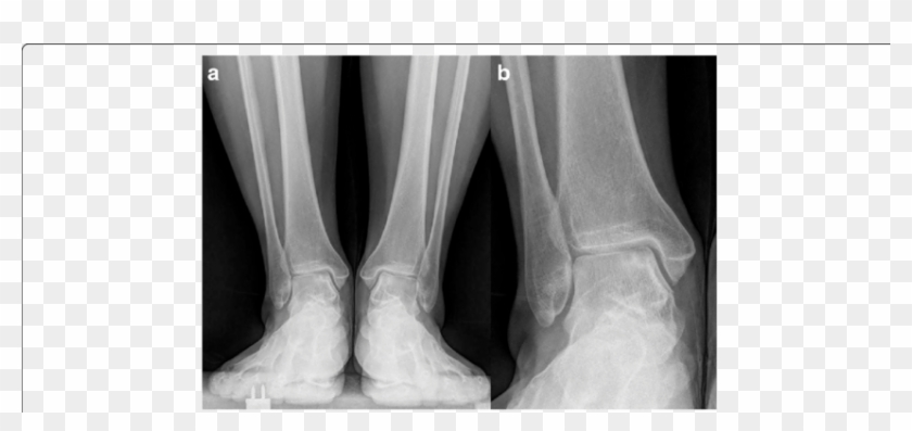 A A 58 Year Old Female With Concomitant Large Olts - Radiography, HD ...