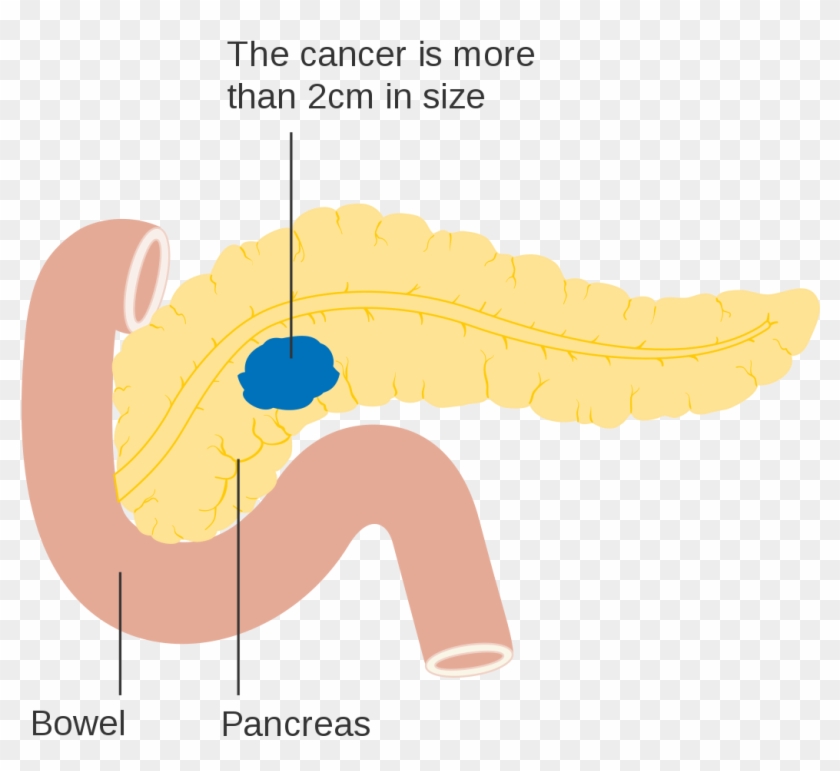 File:Diagram 1 of 2 showing stage 3B breast cancer CRUK 004.svg