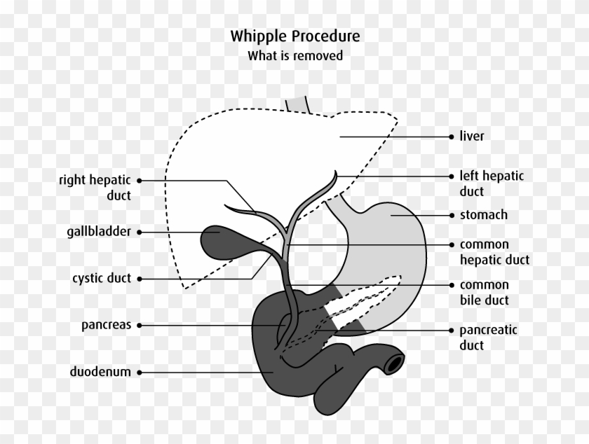 What Is Removed In A Whipple Procedure