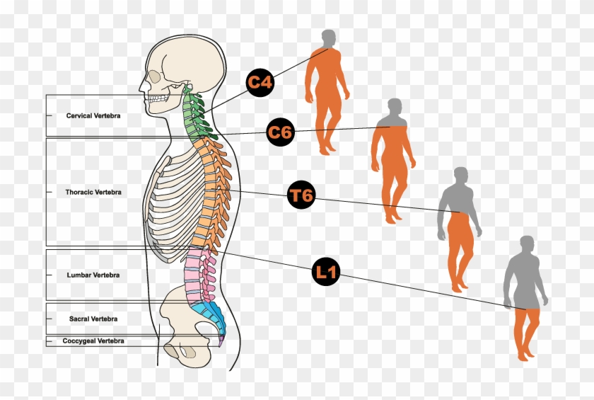 What Are The Different Types Of Spinal Cord Injuries - vrogue.co